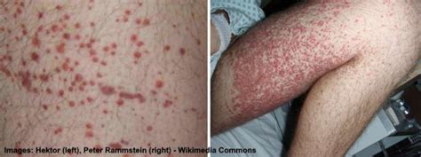Petechiae Causes Symptoms And Treatments Including Images