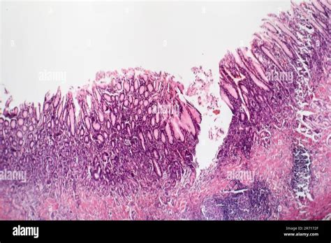 Atrophic Gastritis Histology