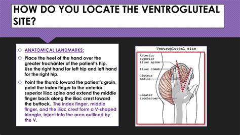 how to find ventrogluteal site