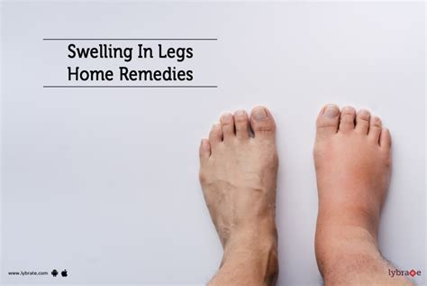 Swelling In Legs Home Remedies By Dr Nandeesh J Lybrate