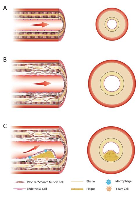 Illustrated Histology Of The Normal Vessel And Histological Alterations