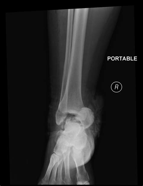 The Extruded Talus Results Of Reimplantation Post Orthobullets