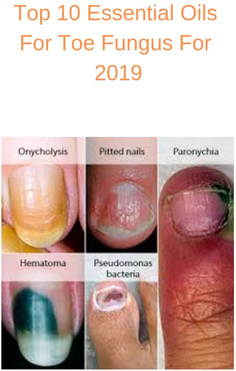 10 Best Essential Oils For Toe Fungus That Work In 2021 Nail Fungus