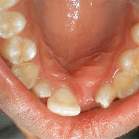 Swelling On The Palatal Aspect Of Upper Jaw Download Scientific Diagram
