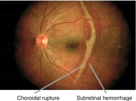 Choroidal Crescent Optic Nerve