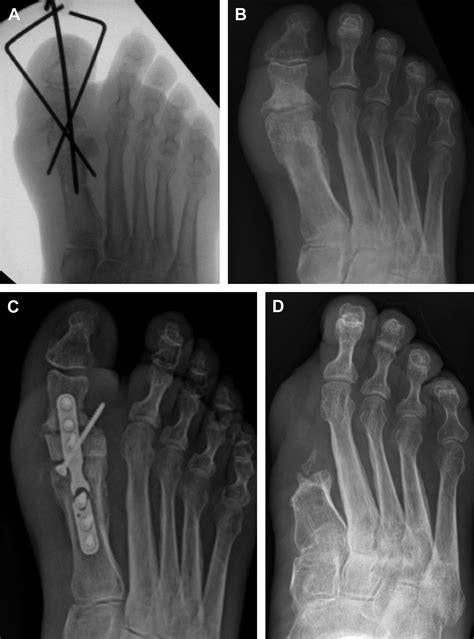 First Metatarsal Phalangeal Joint Arthrodesis Clinics In Podiatric