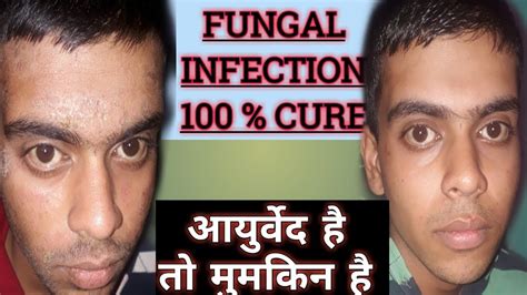 Fungal Infection On Face Permanent Cure Dr Nishant Mishra Youtube