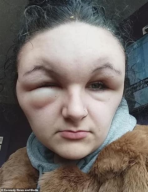 Teenager 18 Rushed To Hospital After Allergic Reaction To A Hair Dye