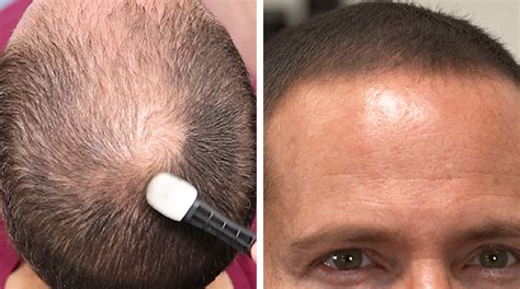 Dermmatch Hair Loss Concealer Great For Thin Hair Or Small Bald Spots