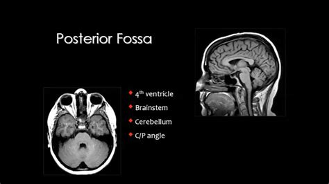 Posterior Fossa Neuropsychology Medical Neurology