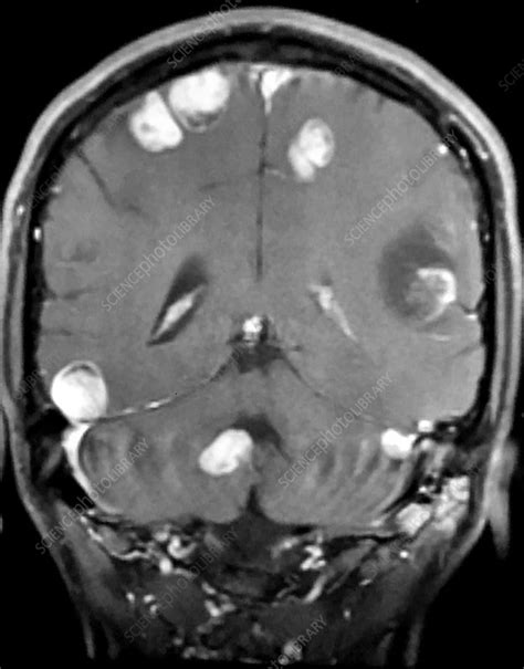 Melanoma Metastatic To Brain Mri Stock Image C0394208 Science