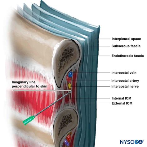 Fluoroscopic Guided Intercostal Nerve Block Technique And Overview
