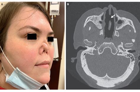 See Womans Nose Collapses Due To Rare Autoimmune Disorder Life
