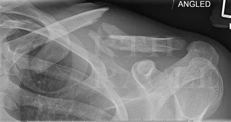 Comminuted Clavicle Fracture Orif With Stryker Variax 2 Locking Plate