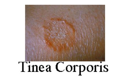 Tinea Corporis Definition 10 Causes Symptoms Diagnosis