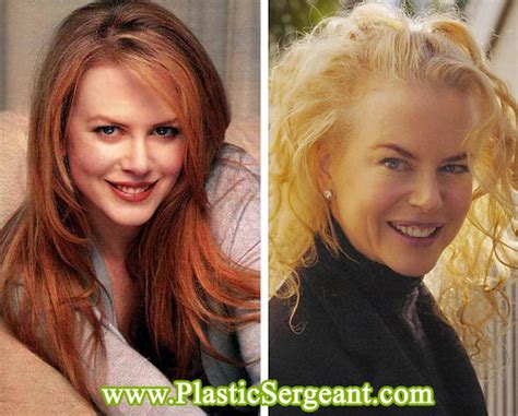 Nicole Kidman After Years Of Botox Flickr Photo Sharing