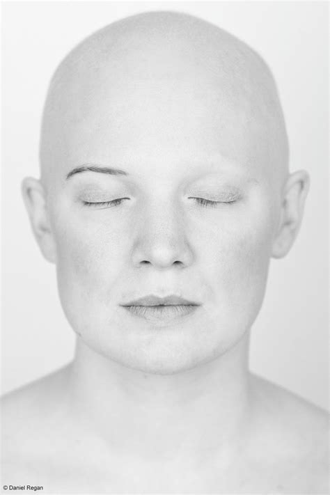 Powerful Photos Of People With Alopecia Prove Bald Is Beautiful