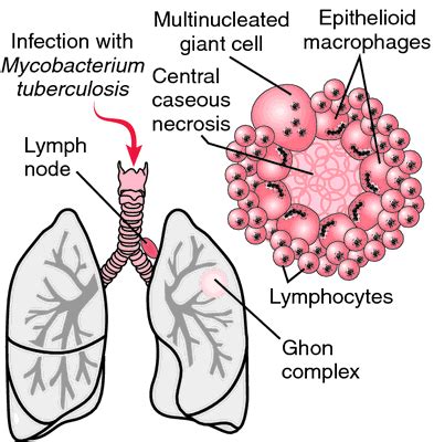 Tuberculosis POTT SYNDROME The Ghon Complex Typical Of Pulmonary
