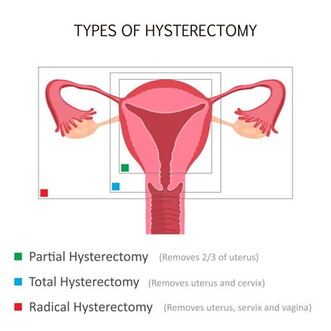 Hysterectomy Cherokee Women S Health
