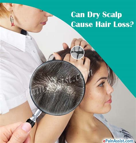 Well, the good news is it's not! Can Dry Scalp Cause Hair Loss?