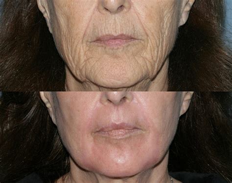 Aging Skin San Diego Ca Cosmetic Laser Dermatology