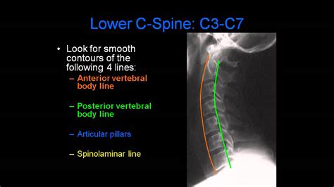 C Spine Radiology