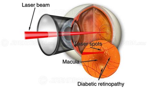 Retinal Laser For Diabetic Retinopathy Suvr0033 Stock Eye Images