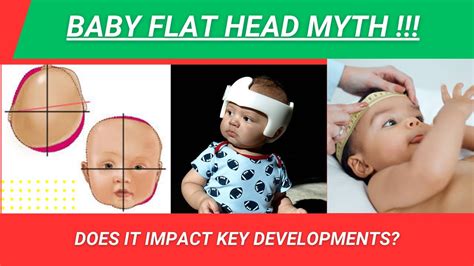 Is Your Babys Development At Risk Due To Flat Head How It Can Effect