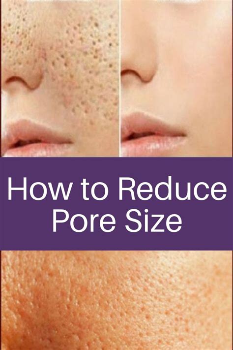 How To Reduce Pore Size In 2020 Reduce Pore Size Huge Pores Reduce