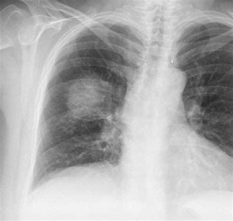 How To Read A Chest Xray Ii Pneumonia Medchrome