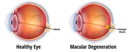 Macular Degeneration Eyecare Associates Of South Tulsa