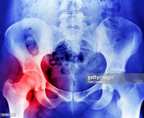 Hip Replacement Surgery Photos And Premium High Res Pictures Getty Images