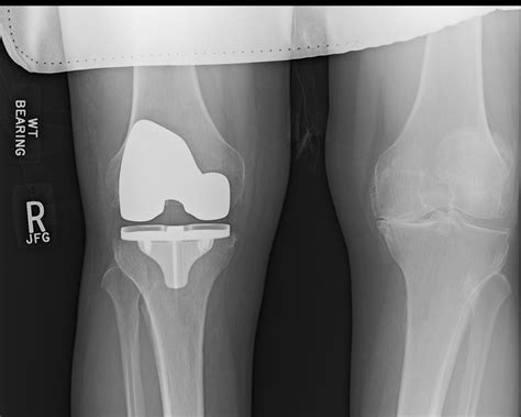 Case Study Pain And Swelling Following Knee Replacement Clinical