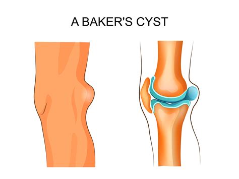 Bakers Cyst Causes And Treatment Direct Orthopedic Care