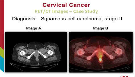 Cervical Cancer A Female Reproductive System Pathology Case Study E