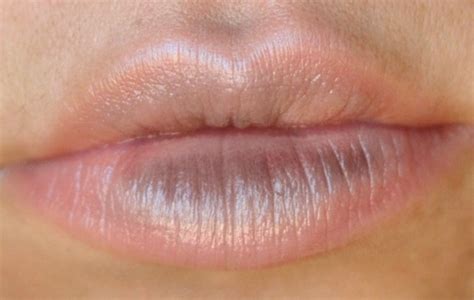 👉 Lip Discoloration Pictures Causes Treatment Remedies December 2021