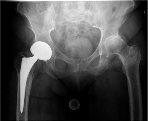 A Preoperative Anteroposterior Pelvic Radiograph Of An Download