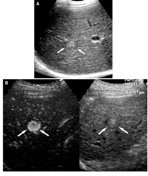 Hepatocellular Nodules In Liver Cirrhosis Contrast Enhanced Ultrasound