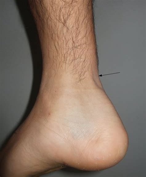 Achilles Tendon Rupture Causes Symptoms And Treatment Bone And Spine