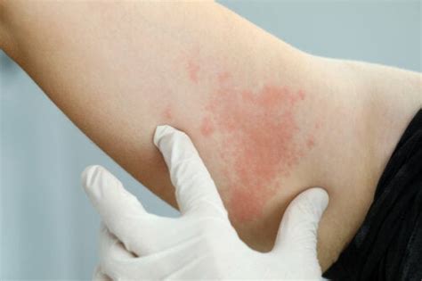 Infections Cutanées Types Causes Et Traitements Alltrends