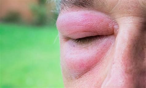 celulitis orbitaria cómo se origina y síntomas quijada medicina ocular