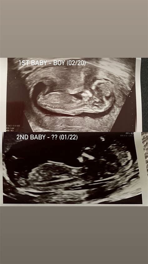 Comparing Scan Photos From 1st Pregnancy BabyCentre