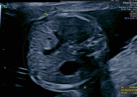 Sonography Assessment Of Gestational Age Article