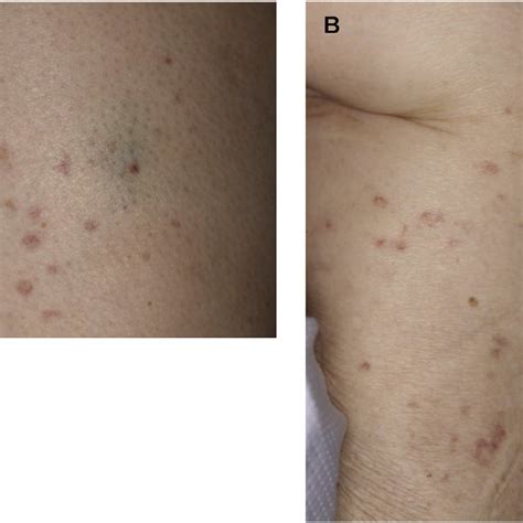 Non Blanching Erythematous Palpable Petechiae And Purpura On The Right