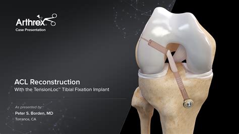Arthrex Acl Reconstruction With The Tensionloc™ Tibial Fixation Implant
