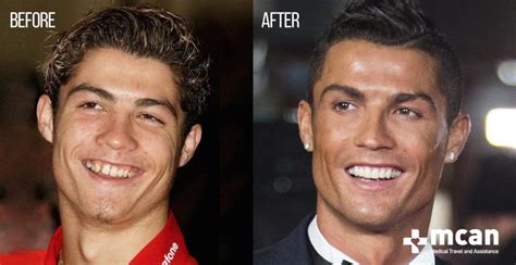 The Truth About Cristiano Ronaldo Plastic Surgeries