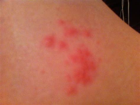 I Have An Area Of Red Raised Spots And Rash On Upper Left Leg