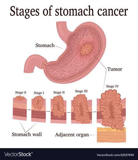 Symptoms Of Stomach Cancer What Are The Early Signs Of Stomach Cancer