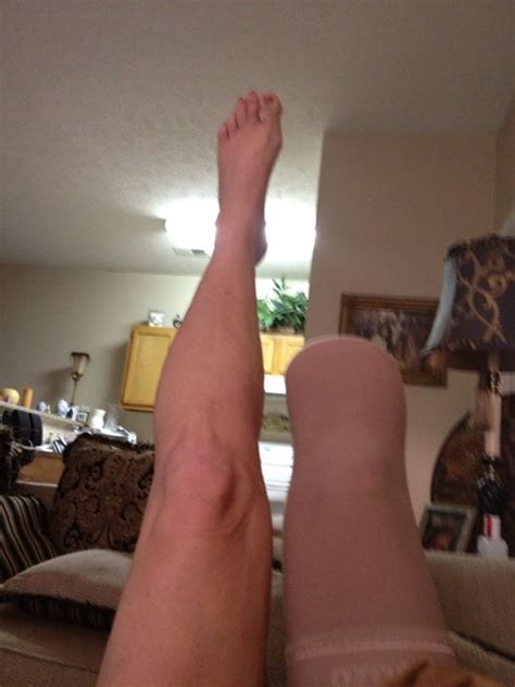Prosthetic Leg By Dawn Phillips Gofundme