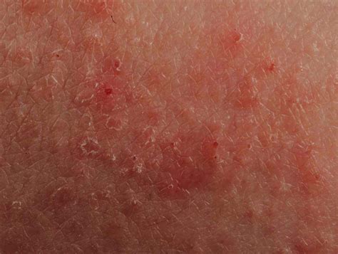 How To Stop Eczema Itching Immediately Blog